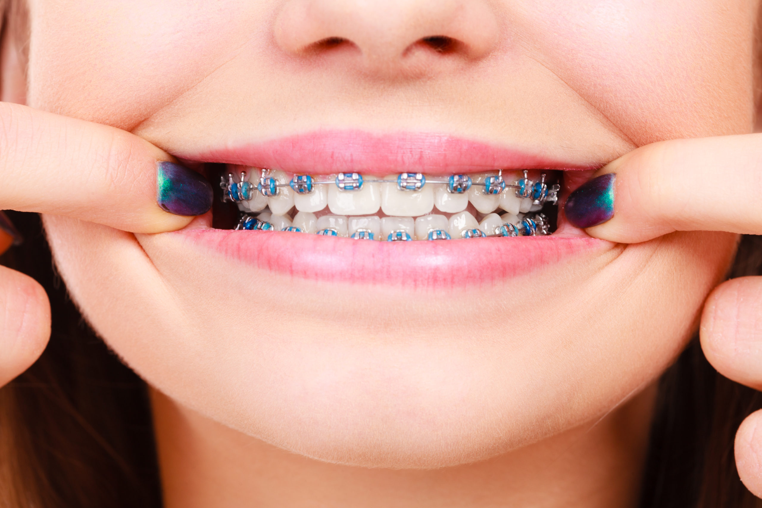 Do Braces Hurt? What to Expect Urban Orthodontics