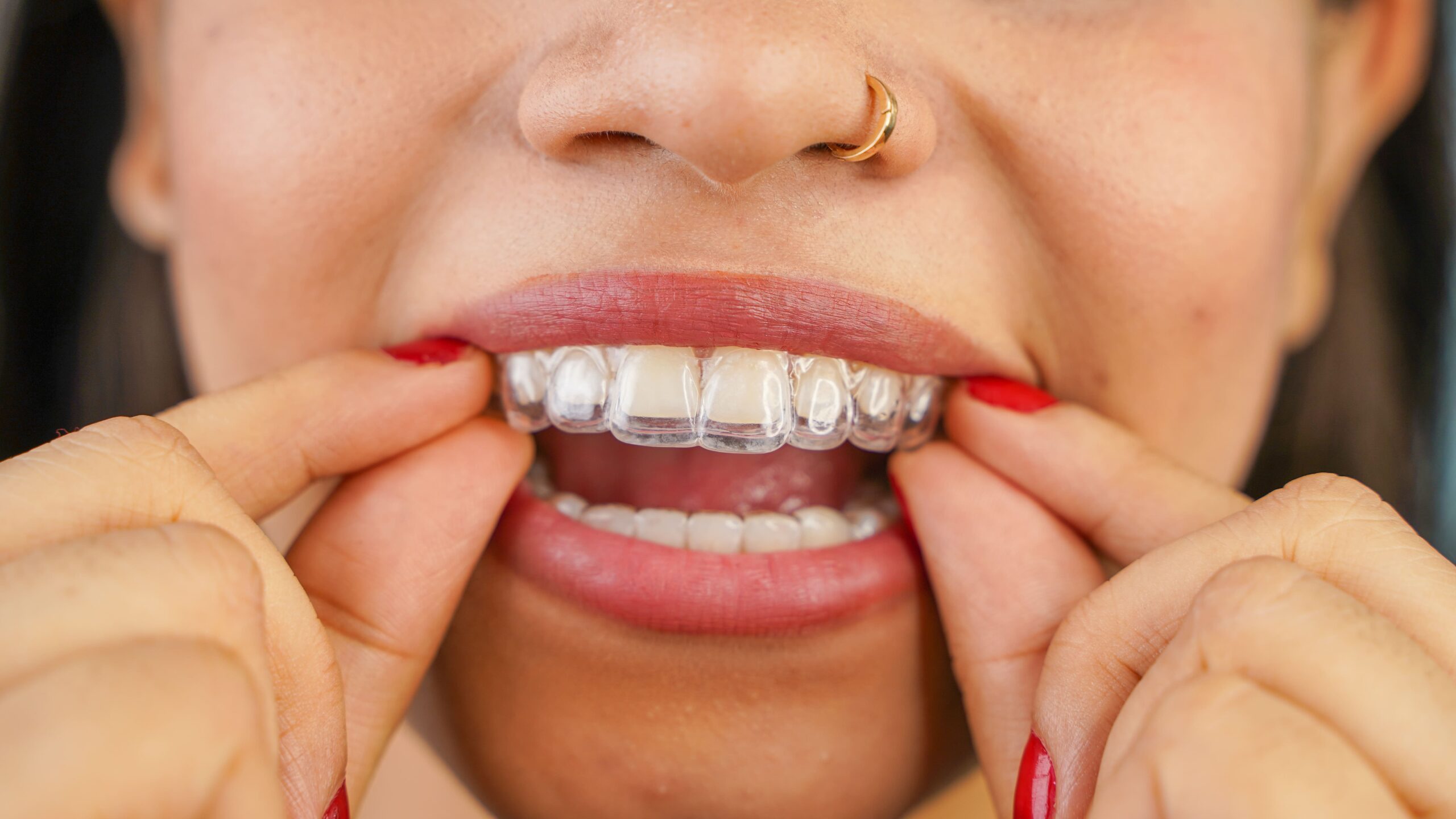 invisalign aligners near me